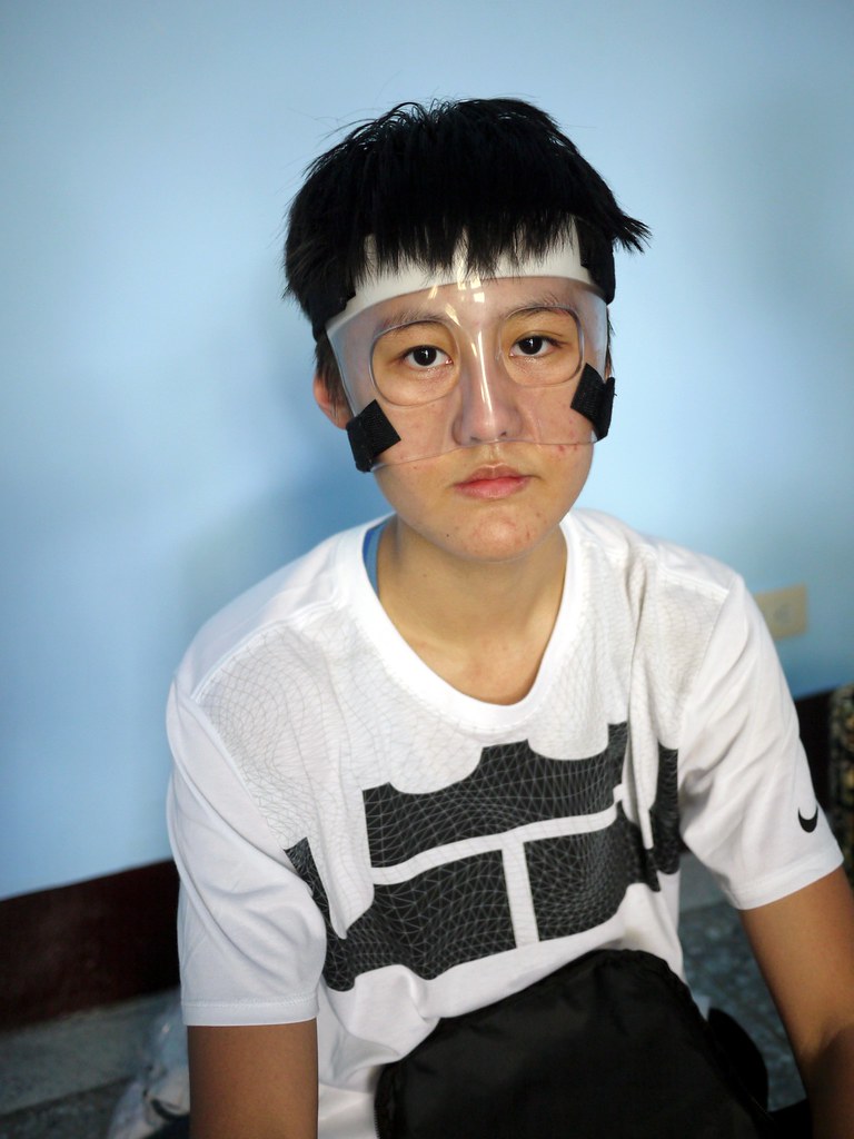 鼻樑1個月斷3次　羅培甄成面具俠