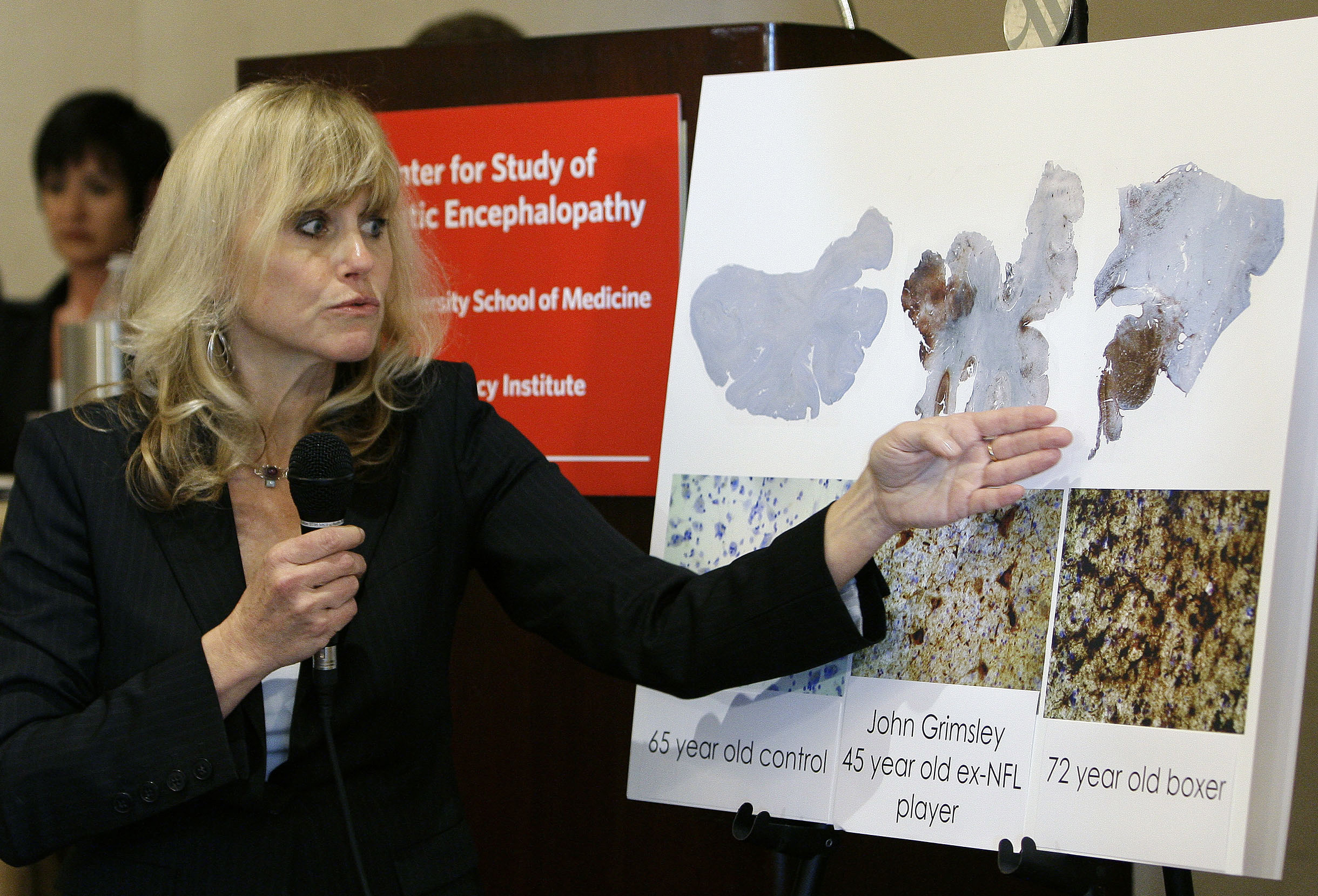 前美足選手捐贈大腦　近9成罹患CTE