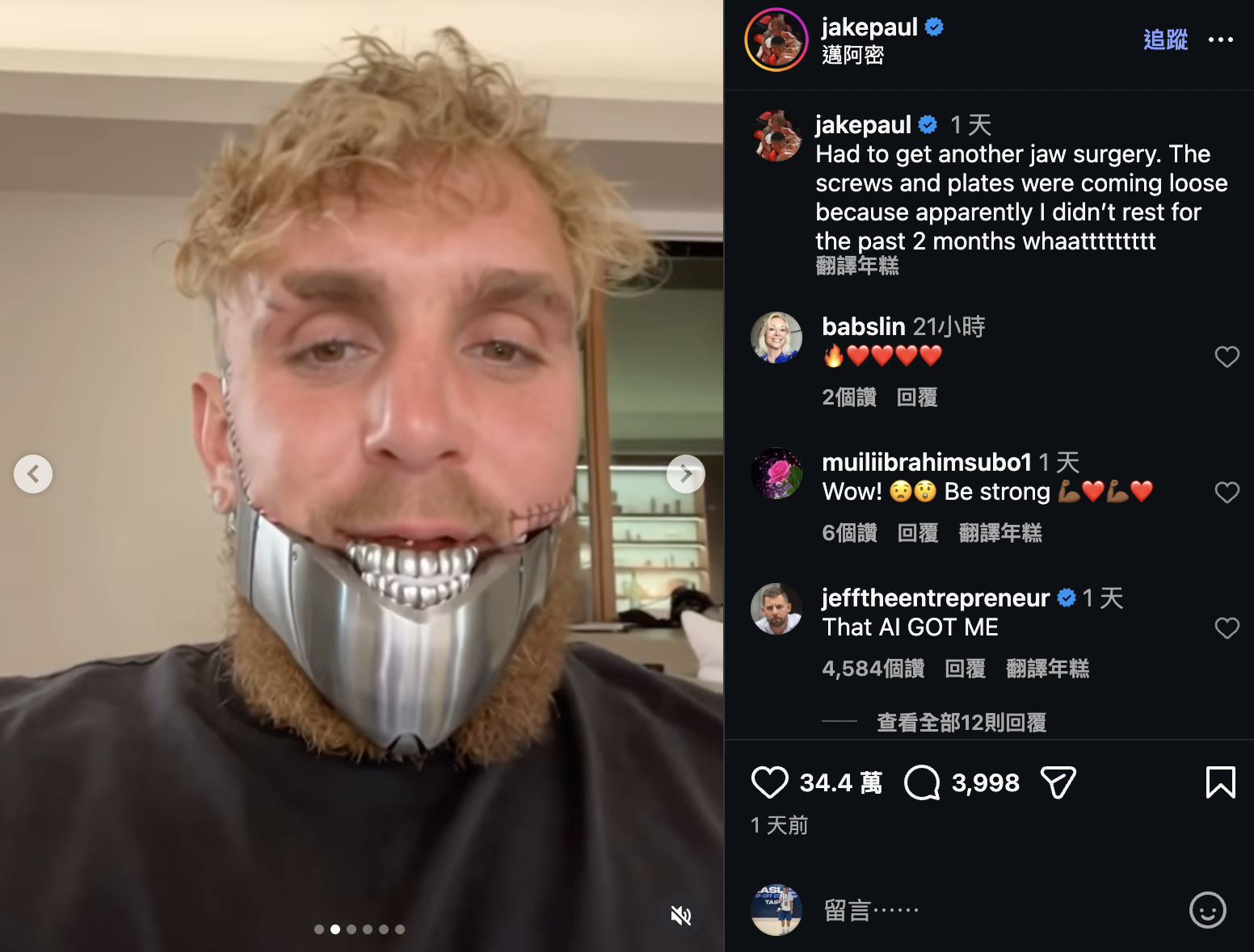 拳擊》遭到重擊後　網紅拳手Jake Paul下顎又要手術　因為螺絲、鋼板鬆脫